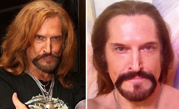 11. Никита Джигурда с помощью пластической хирургии убрал мешки под глазами