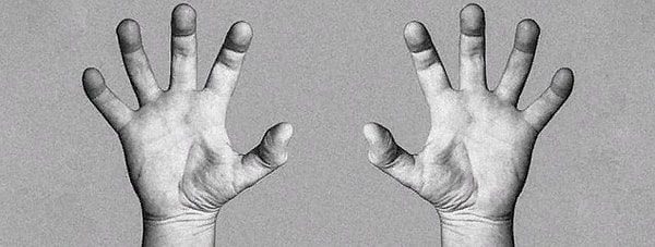 2. Он ходил со следами порезанных вен, чтобы напугать друзей и подчеркнуть, как сильно он переживает свои проблемы в отношениях.