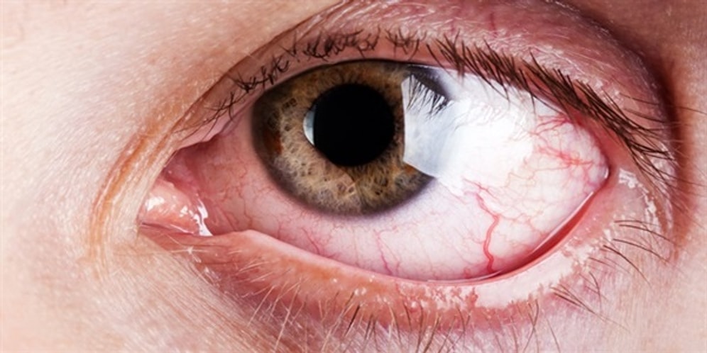 Gözümüz Neden Çapaklanır Hiç Merak Ettiniz mi?