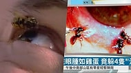 Enfeksiyon İçin Gittiği Doktorda Gözünün İçerisinde Gözyaşıyla Beslenen Dört Tane Arı Olduğunu Öğrenen Talihsiz Kadın