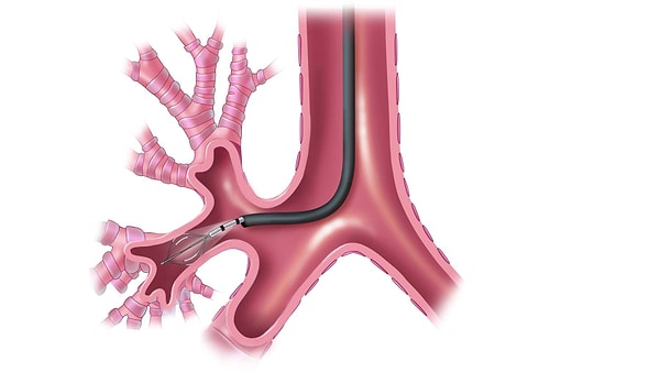 3. Bronşiyal termoplastiyle insanlık olarak astım krizlerinden sonsuza dek kurtulmaya çok yakınız.