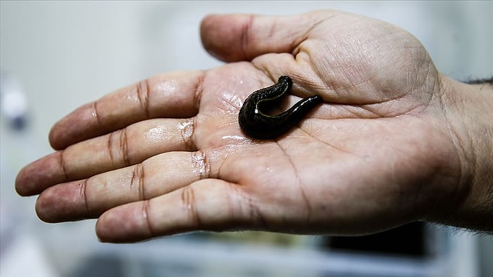Devlet Hastanesi İhale Açtı: 60 Sülük, 350 Hacamat Kupası Alınacak