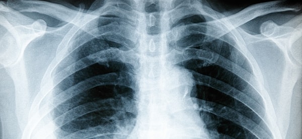 6. Плеврит (воспаление оболочек, которые окружают каждое легкое):