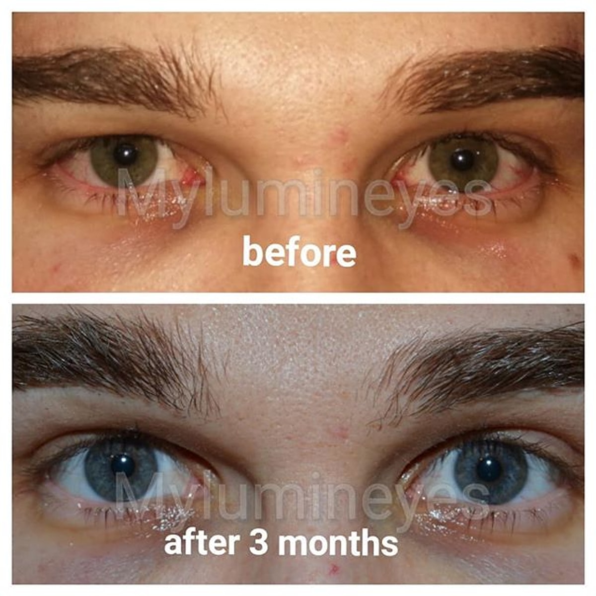 Siz Şaşırmış Olmalısınız! Göz Rengi Değiştirme Operasyonu Hakkında ...