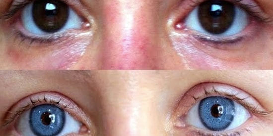 Siz Şaşırmış Olmalısınız! Göz Rengi Değiştirme Operasyonu Hakkında Merak Edilenler