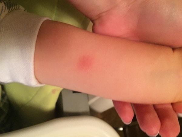 1. Для диагностики чего ставят пробу Манту?