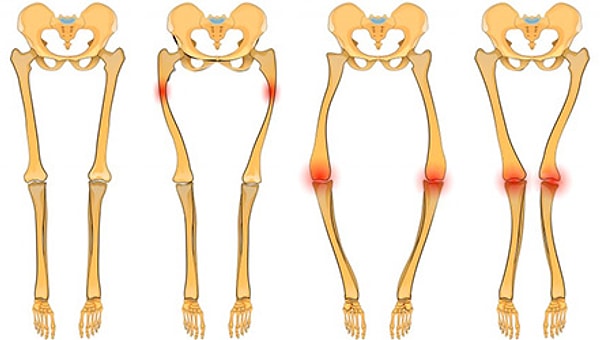 8. Как раньше называли болезнь рахит?