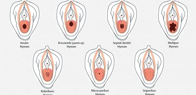 Çok büyük mesele haline gelen bekaret zarından da bahsetmeden olmaz.