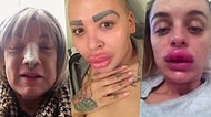 Kendilerini Sürekli Değiştirmek İstedikleri İçin Bıçak Altına Yatıp Geri Dönülmez Estetik Facialarıyla Karşılaşan İnsanlar