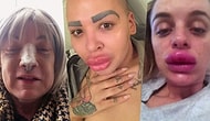 Kendilerini Sürekli Değiştirmek İstedikleri İçin Bıçak Altına Yatıp Geri Dönülmez Estetik Facialarıyla Karşılaşan İnsanlar