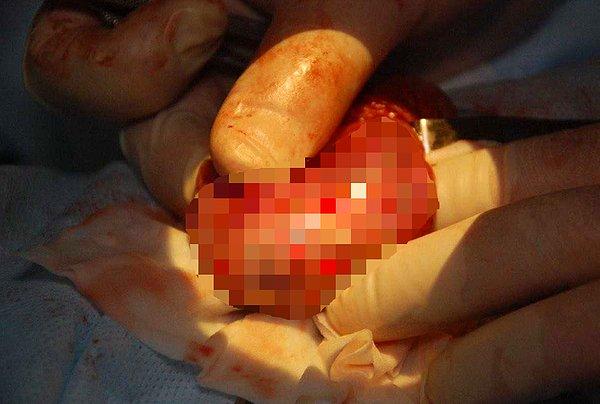Moskova'da bulunan Morozov Çocuk Hastanesi doktorları, 13 yaşındaki çocuğun testislerindeki yumruyu görünce bir çeşit tümör olduğunu düşünerek direkt operasyona karar verdiler.
