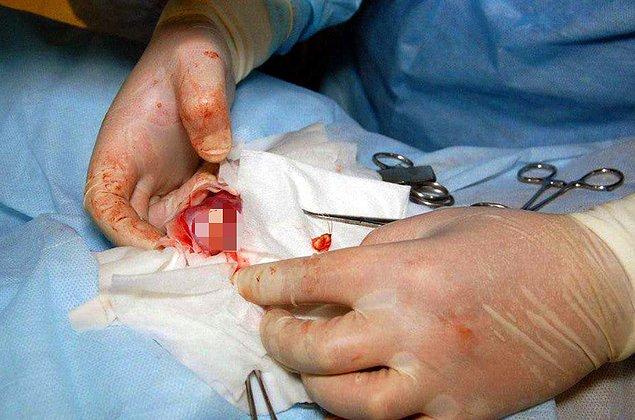 Bütün operasyonlar içerisinde en nadir görüleni, cerrah Dmitry Tarusin tarafından gerçekleştirildi.