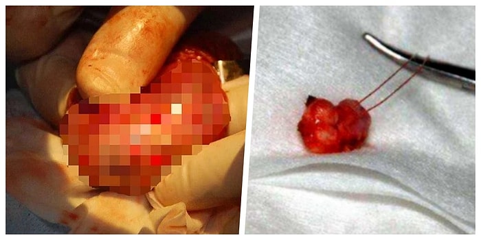 Tıp Dünyasında Bir İlk: Doktorlar, 13 Yaşındaki Çocuğun Testislerinden Azı Diş Çıkarttılar!