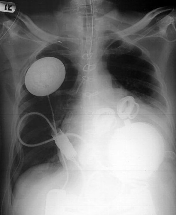 5. Yapay kalp yerleştirilen bir hastanın vücudu: