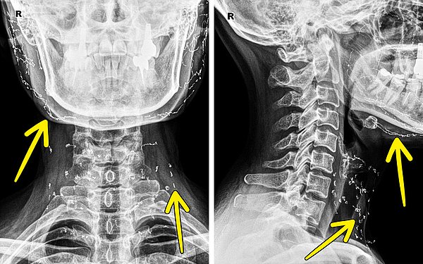 8. Yüz gerdirme operasyonu geçiren bir kadının röntgende görülen altın ipliği: