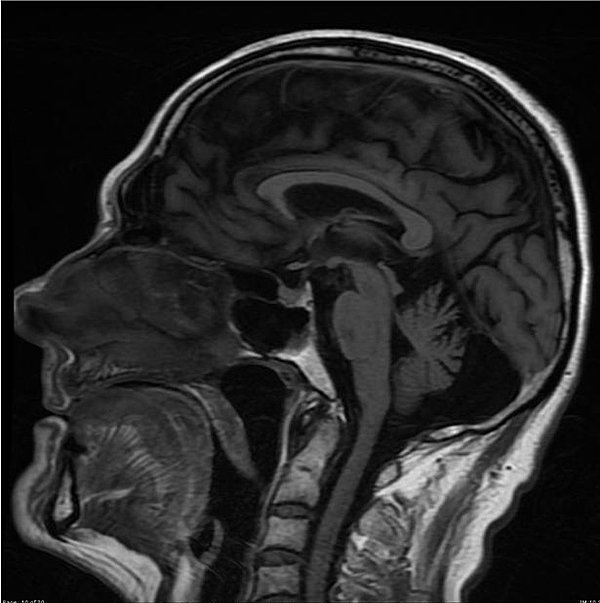 13. Alkolden ötürü vermian atrofisini gösteren bir röntgen. Alkol nedeniyle beyin ve beyincik küçülmüş durumda.