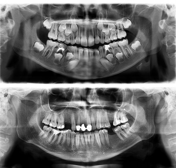 17. 7 yaşındaki (üstte) ve 30 yaşındaki (altta) kişilerin dişleri: