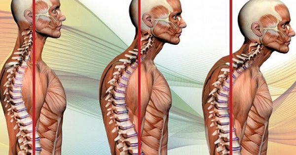 5. Как в медицине называют анатомический горб?