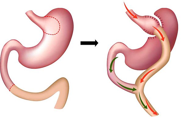 Gastrik Bypass