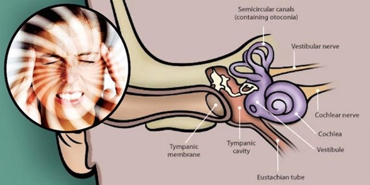 ataklar basladigi anda dunyayi yerle bir eden vertigo hakkinda bilmeniz gerekenler