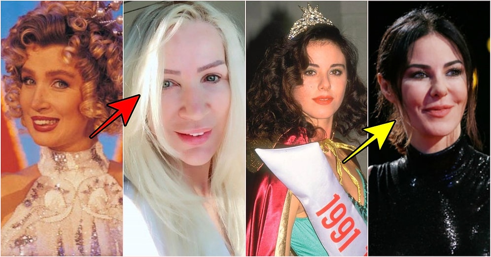 Kırışıklıklara Savaş Açayım Derken Botoksun Ayarını Kaçırıp Bambaşka Birine Dönüşen Ünlüler