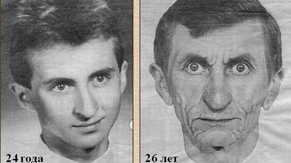 10. Как называется синдром преждевременного старения?