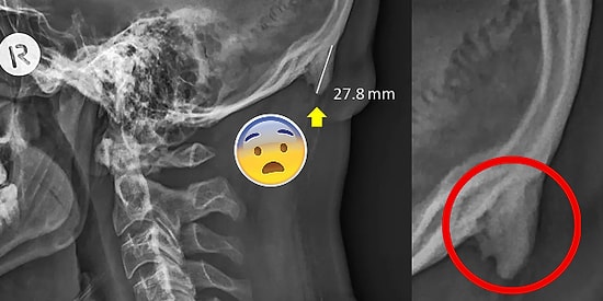 Şaka Yapmıyoruz, Telefonunuzla Çok Haşır Neşir Olmak Kafatasınızda Boynuz Çıkmasına Neden Olabilir!