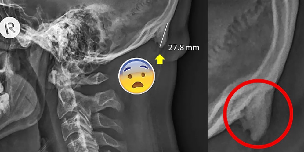 Şaka Yapmıyoruz, Telefonunuzla Çok Haşır Neşir Olmak Kafatasınızda Boynuz Çıkmasına Neden Olabilir!