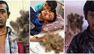 Bangladeşli 'Ağaç Adam' Çektiği Acılara Daha Fazla Katlanamadığı İçin Ellerinin Kesilmesini İstiyor