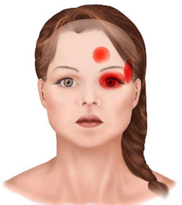 2. Şiddetli olan ve başın bir tarafında, tipik olarak göz çevresinde meydana gelen baş ağrıları: