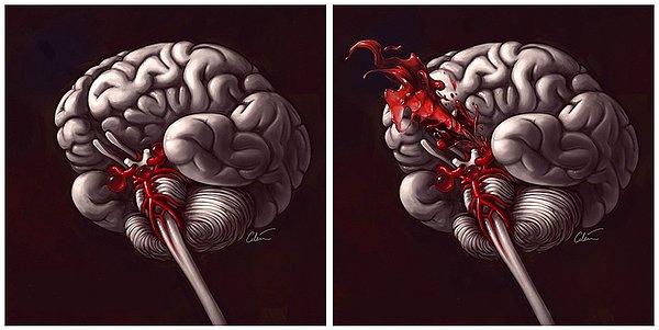 1. Beyin anevrizması, kısa ve uzun süreli hafıza kaybına neden olabilir.
