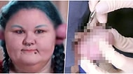 Yıllar Önce Yaptırdığı Piercing Nedeniyle Kulağında Yaklaşık Yarım Kiloluk Acı Verici Kitle Oluşan Kadın