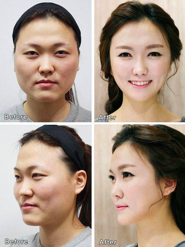 13. "Geçirdiğim birçok estetik operasyonundan önce ve sonra:"