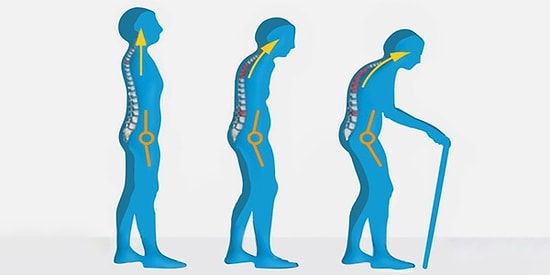 Kadınların Yüzde 80'inde Görülen Osteoporoz Riskini Artıran Faktörler