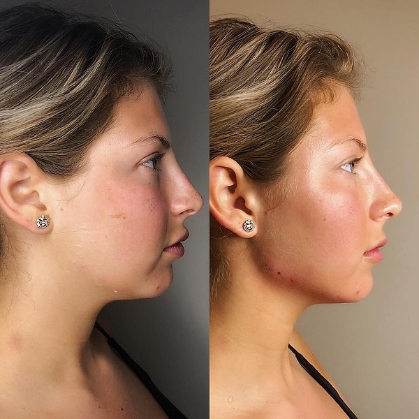 Возьмем, к примеру, последний тренд - коррекцию овала лица.