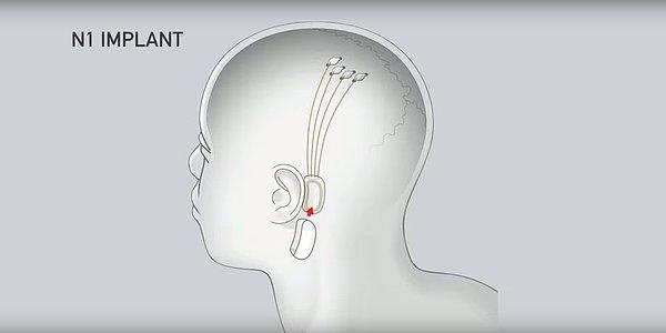 Mevcut tasarımda, beynin içine giren ve nöronları veya sinir hücrelerini uyarabilecek ve insan saçının genişliğinin dörtte biri kadar elektrot ipliklerine bağlı olan bir çip, kulağın arkasına yerleştiriliyor.