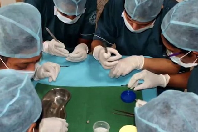 Genel anesteziden sonra çenesi açılan çocuğun çenesinden 200 gramlık bir kitle çıktı ve içinde 526 tane büyüklü küçüklü diş bulunuyordu.