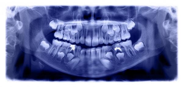 Ücretsiz olarak yapılan ameliyat sonrasında 7 yaşındaki hastanın ağzında 21 tane normal diş kaldı.