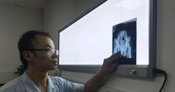 Hastanenin üroloji birimi doktoru Wang Shenhxing, çocuğun daha küçük bir hastaneden oraya gönderildiğini ve hemen incelemeye alındığını söyledi.