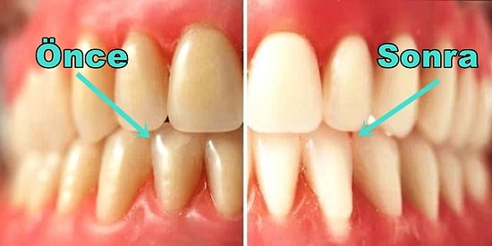 Sağlıklı Dişler ve Çok Daha Güzel Bir Gülüş İçin Hemen Uygulamaya Başlamanız Gereken 11 Alışkanlık