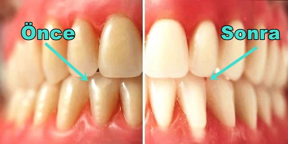 Sağlıklı Dişler ve Çok Daha Güzel Bir Gülüş İçin Hemen Uygulamaya Başlamanız Gereken 11 Alışkanlık