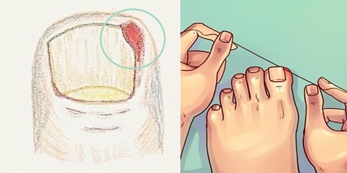 Bir Başladı mı Asla Bitmeyen İllet: Tırnak Batmasını Önlemek İçin Bilmeniz Gerekenler