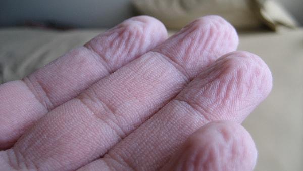 6. Bir parmakta sinir zedelenmesi varsa o parmak su altında buruşmaz.