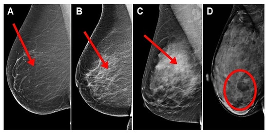 Kanser Riskini Artıran Meme Dokusu Yoğunluğu Hakkında Her Kadının Mutlaka Bilmesi Gerekenler