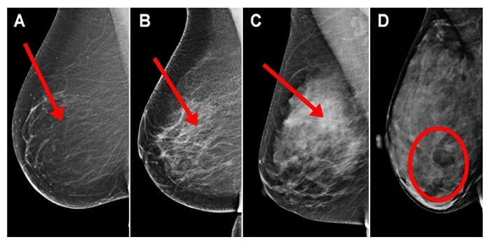 Kanser Riskini Artıran Meme Dokusu Yoğunluğu Hakkında Her Kadının Mutlaka Bilmesi Gerekenler