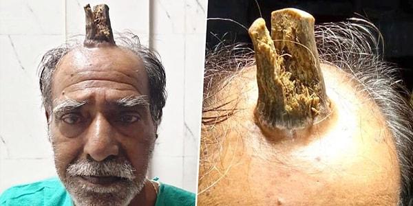 Hindistanlı bir adamın kafasının üst kısmında çıkan 'şeytan boynuzu' sonunda operasyonla alındı.