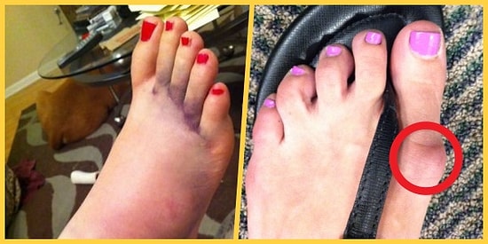Parmak Arası Terlikle Her Yere Gidiyorsanız Her Şey İçin Geç Olmadan Bu Anlatacaklarımıza Kulak Vermeniz Şart!