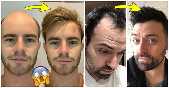 Kelin Merhemi Varmış! Yaptırdıkları Saç Protezinden Sonra Adeta Birer Best Model'e Dönüşen 34 Erkek