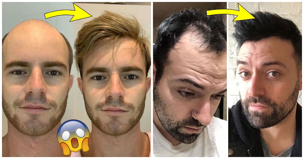 Kelin Merhemi Varmış! Yaptırdıkları Saç Protezinden Sonra Adeta Birer Best Model'e Dönüşen 34 Erkek