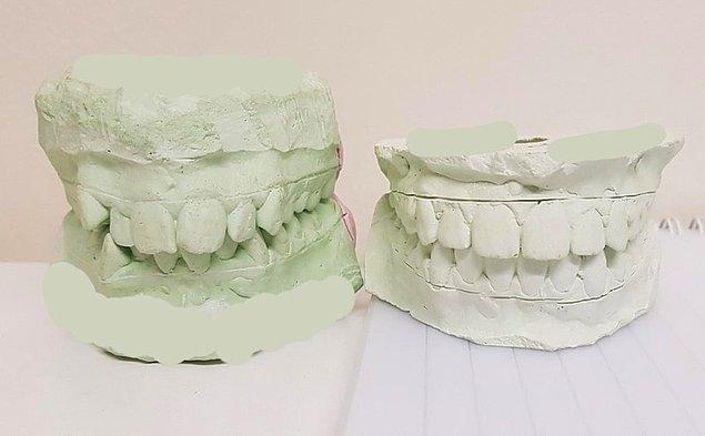 6. Diş teli öncesi ve sonrası: